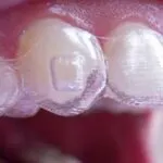 تقويم الاسنان الشفاف
