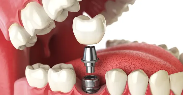 Dental implant prices