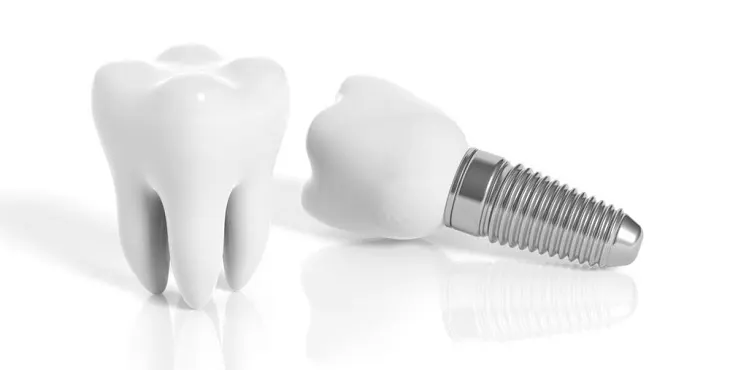 Types of dental implants