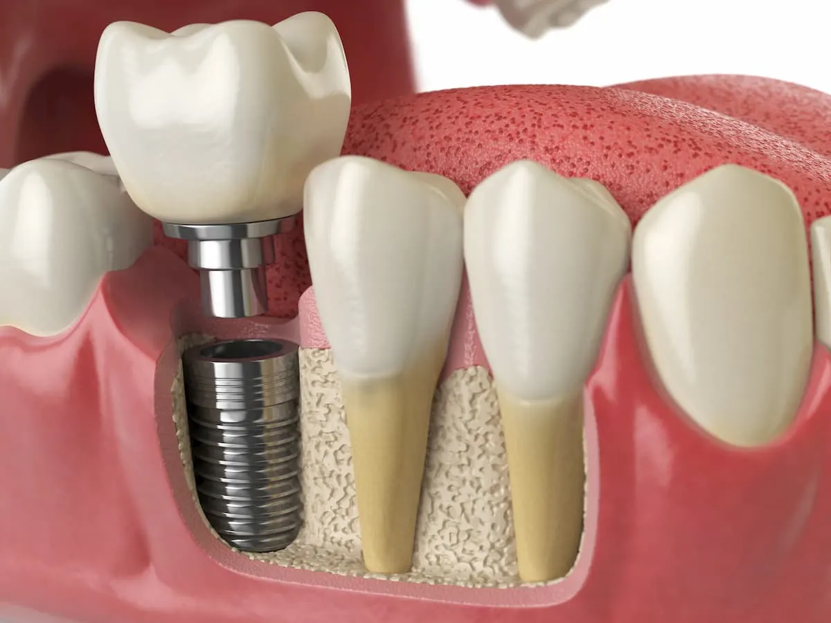 Types of dental implants