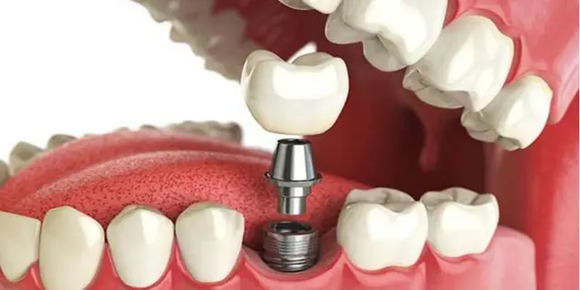 Types of dental implants