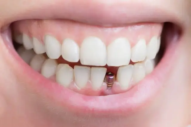 My experience with dental implants in Saudi Arabia