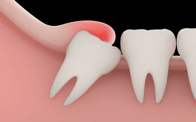 Wisdom tooth surgery