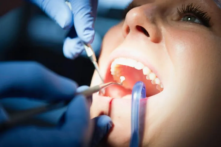 حشوات الاسنان التجميلية