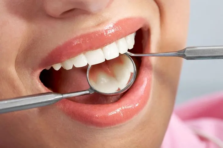 حشوات الاسنان التجميلية