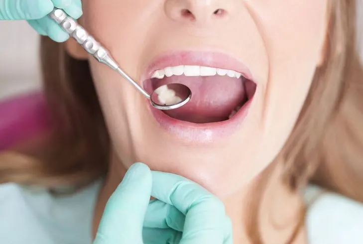 Front tooth filling
