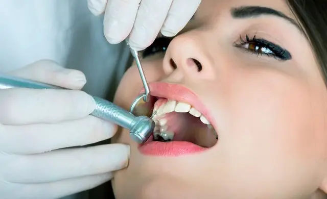 Front tooth filling